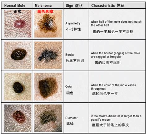 痣上面長痘痘|痣里面长痘痘是癌变吗